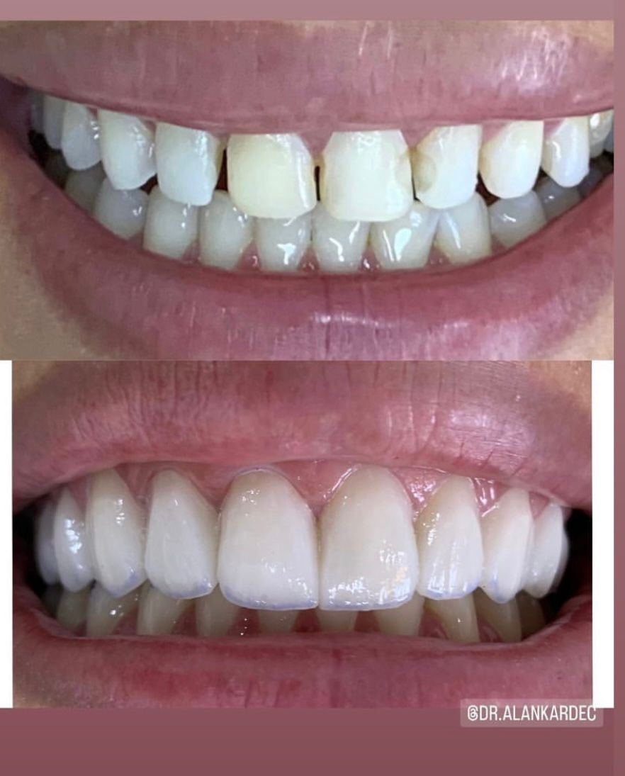 Depois — Clareamento dental