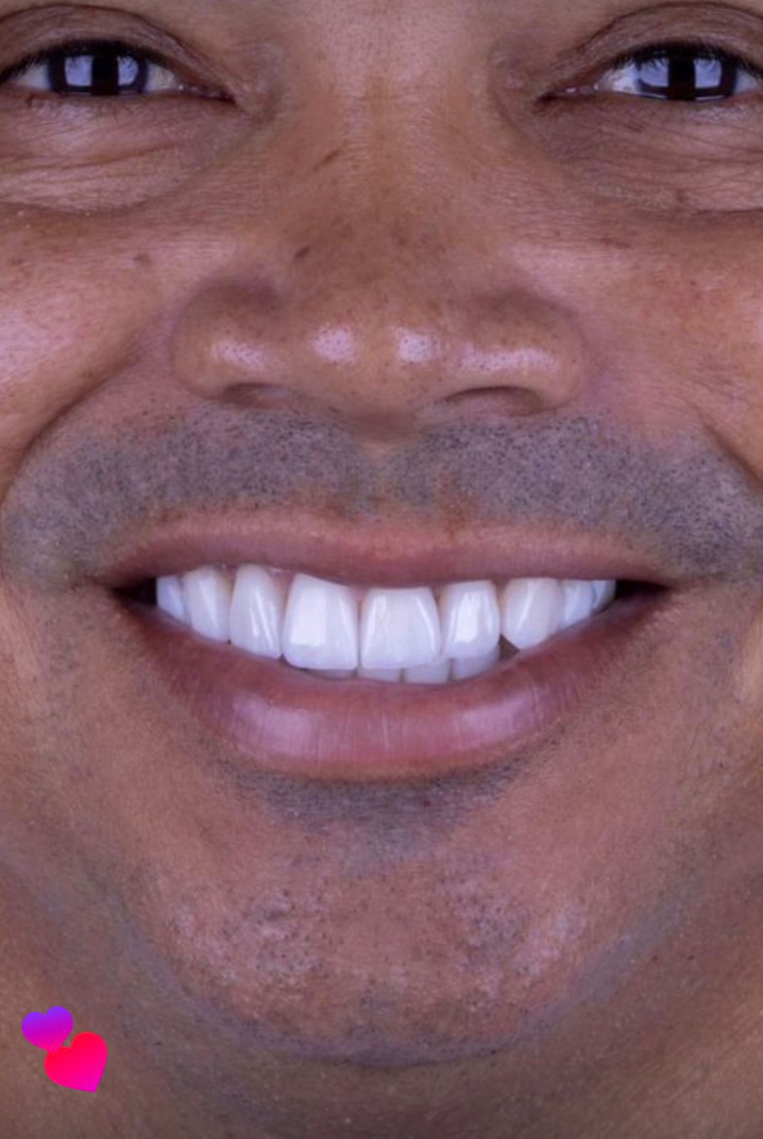 Antes — Clareamento dental