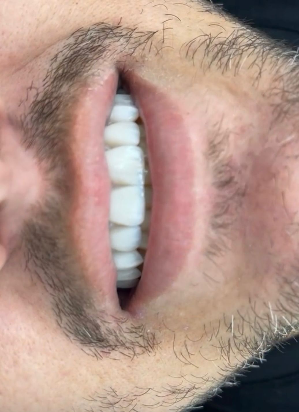 Antes — Aparelho ortodôntico